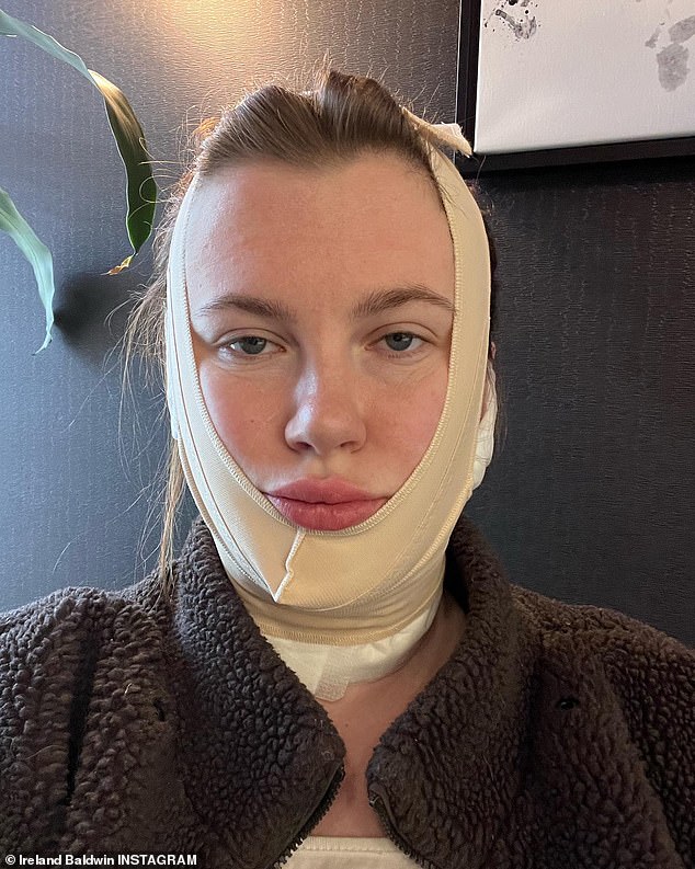 Die Heilung: In einem neuen Instagram-Video, das am Dienstagnachmittag veröffentlicht wurde, erklärte das 26-jährige Model, dass FaceTite ein minimal-invasives, einstündiges Verfahren in der Praxis ist, das nicht einmal eine Anästhesie erfordert.