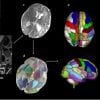 Dies zeigt Gehirnscans in der perinatalen Phase, die Bereiche hervorheben, die mit Autismus in Verbindung stehen